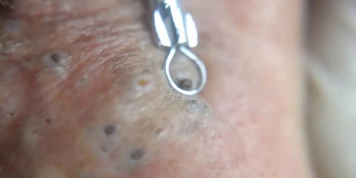 The Absolute Best Way To Extract Blackheads, According To A Dermatologist
